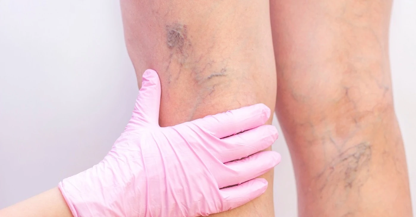 Gloved hand examining varicose and spider veins on a leg