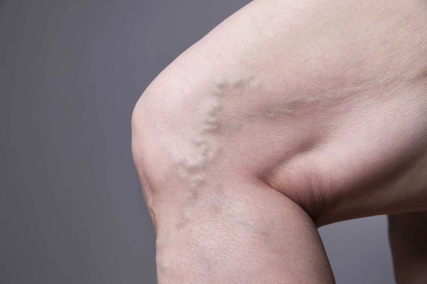 Close-up of varicose veins on the back of a knee