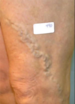 varicose veins