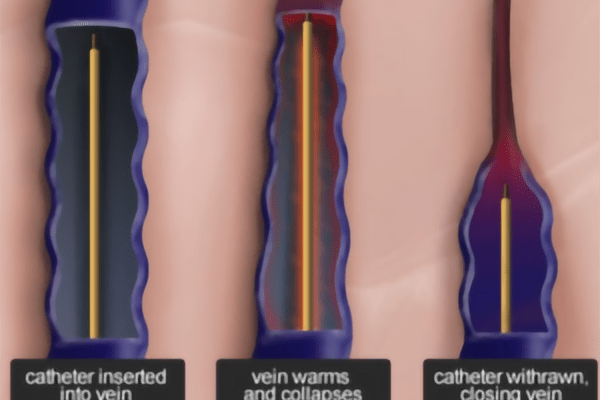 loop-medical-center-varicose-vein-radiofrequency-nerve-ablation