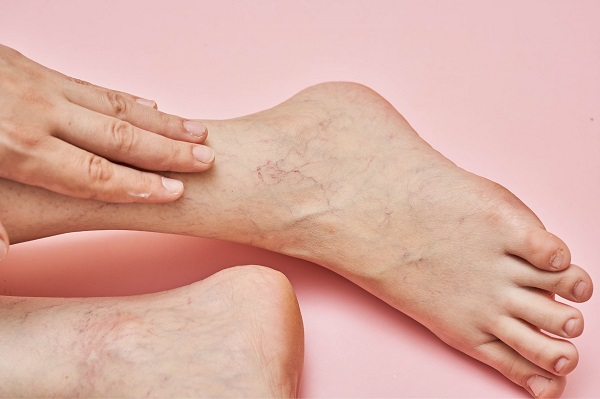 What should you know about veins that are bulging, swollen, or painful? -  Loop Medical Center